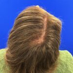 Hair transplant for women