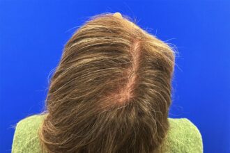 Hair transplant for women