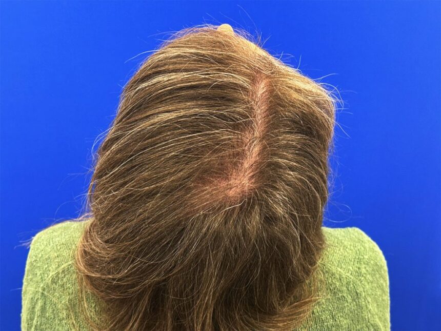 Hair transplant for women